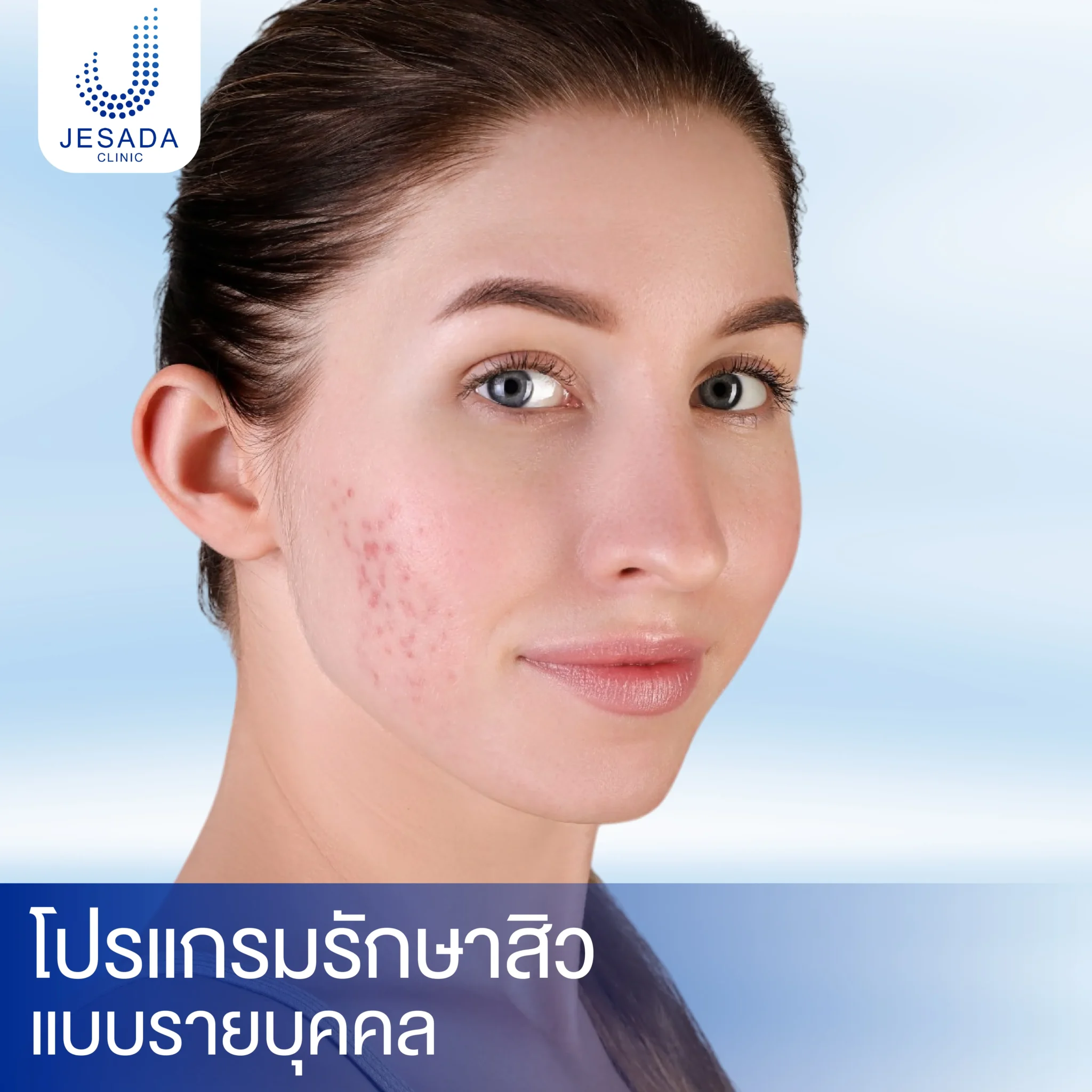 โปรแกรมรักษาสิวแบบรายบุคคล