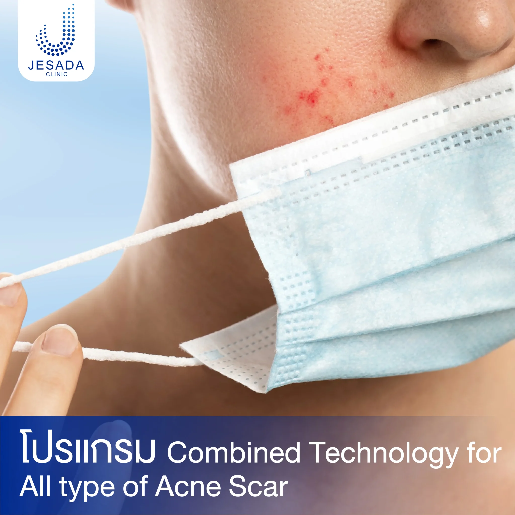 โปรแกรม Combined Technology for All type of Acne Scar